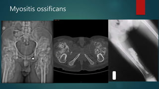 Myositis ossificans
 