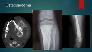 Osteosarcoma
 