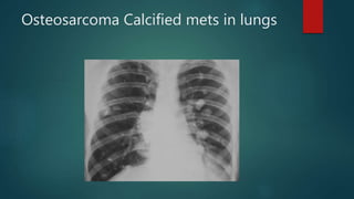 Osteosarcoma Calcified mets in lungs
 