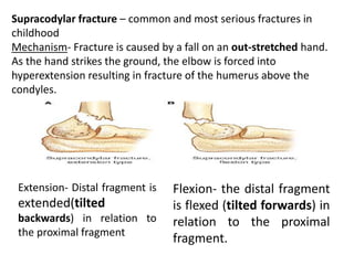 Supracodylar fracture – common and most serious fractures in
childhood
Mechanism- Fracture is caused by a fall on an out-stretched hand.
As the hand strikes the ground, the elbow is forced into
hyperextension resulting in fracture of the humerus above the
condyles.
Extension- Distal fragment is
extended(tilted
backwards) in relation to
the proximal fragment
Flexion- the distal fragment
is flexed (tilted forwards) in
relation to the proximal
fragment.
 