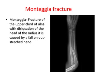 Monteggia fracture
• Monteggia- Fracture of
the upper-third of ulna
with dislocation of the
head of the radius.it is
caused by a fall on out-
streched hand.
 