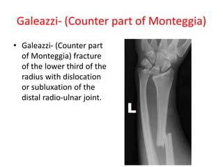 Galeazzi- (Counter part of Monteggia)
• Galeazzi- (Counter part
of Monteggia) fracture
of the lower third of the
radius with dislocation
or subluxation of the
distal radio-ulnar joint.
 
