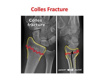 Colles Fracture
 