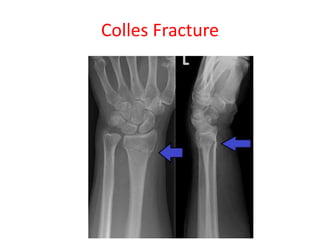Colles Fracture
 
