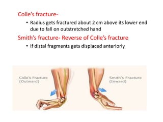 Colle’s fracture-
• Radius gets fractured about 2 cm above its lower end
due to fall on outstretched hand
Smith’s fracture- Reverse of Colle’s fracture
• If distal fragments gets displaced anteriorly
 
