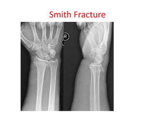 Smith Fracture
 
