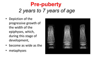Pre-puberty
2 years to 7 years of age
• Depiction of the
progressive growth of
the width of the
epiphyses, which,
during this stage of
development,
• become as wide as the
• metaphyses
 