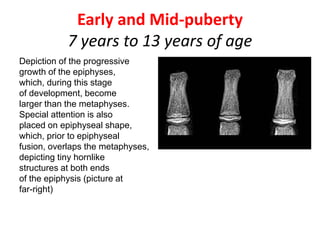 Early and Mid-puberty
7 years to 13 years of age
Depiction of the progressive
growth of the epiphyses,
which, during this stage
of development, become
larger than the metaphyses.
Special attention is also
placed on epiphyseal shape,
which, prior to epiphyseal
fusion, overlaps the metaphyses,
depicting tiny hornlike
structures at both ends
of the epiphysis (picture at
far-right)
 