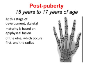 Post-puberty
15 years to 17 years of age
At this stage of
development, skeletal
maturity is based on
epiphyseal fusion
of the ulna, which occurs
first, and the radius
 