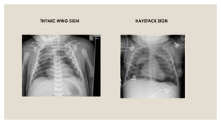 Triangular Sign Chest Radiology Lot Class: Key Radiological Signs in Pulmonary Medicine | PPTX