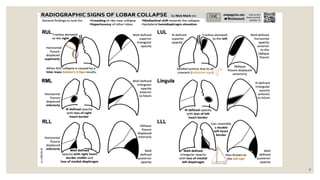 Radiology Lot Class: Key Radiological Signs in Pulmonary Medicine | PPTX