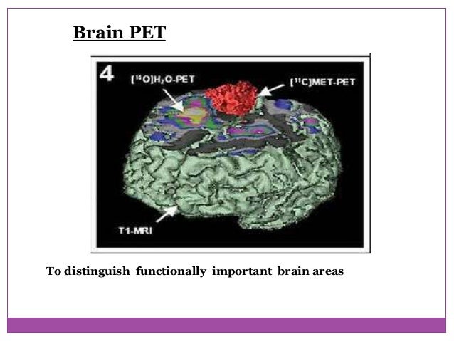 Radionucleide imaging of the brain