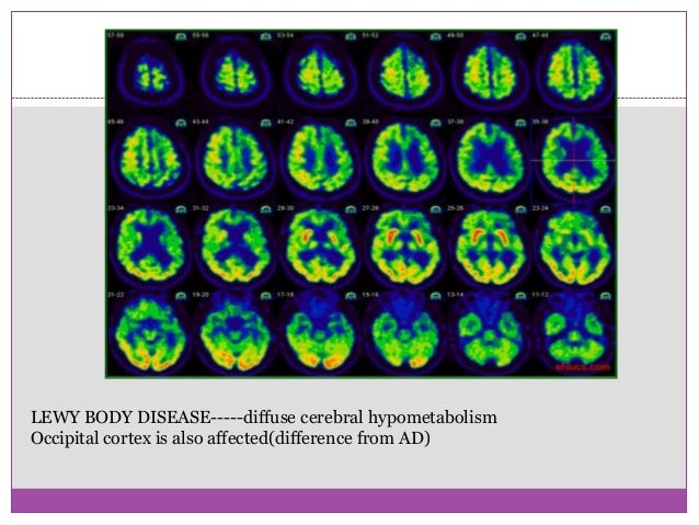 Radionucleide imaging of the brain