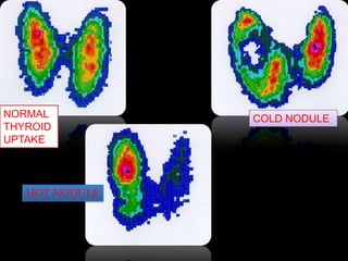 NORMAL
THYROID
UPTAKE

HOT NODULE

COLD NODULE

 