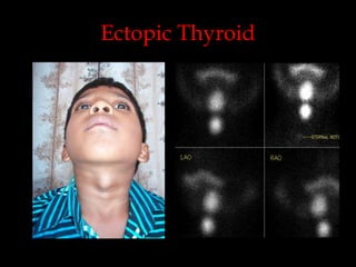 Ectopic Thyroid

 