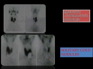 SOLITARY COLD
NODULES

 