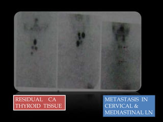 RESIDUAL CA
THYROID TISSUE

METASTASIS IN
CERVICAL &
MEDIASTINAL LN

 