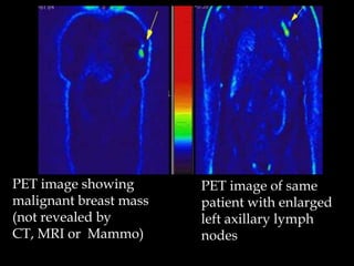 PET image showing
malignant breast mass
(not revealed by
CT, MRI or Mammo)

PET image of same
patient with enlarged
left axillary lymph
nodes

 
