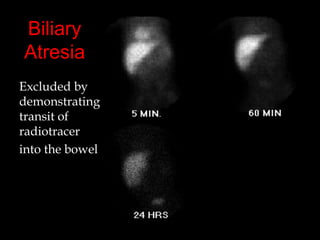 Biliary
Atresia
Excluded by
demonstrating
transit of
radiotracer
into the bowel

 