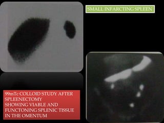 SMALL INFARCTING SPLEEN

99mTc COLLOID STUDY AFTER
SPLEENECTOMY
SHOWING VIABLE AND
FUNCTONING SPLENIC TISSUE
IN THE OMENTUM

 