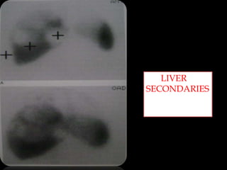 LIVLIVER
SECONDARIES
ER
SECONDARIES

 