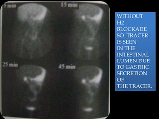 WITHOUT
H2
BLOCKADE
SO TRACER
IS SEEN
IN THE
INTESTINAL
LUMEN DUE
TO GASTRIC
SECRETION
OF
THE TRACER.

 