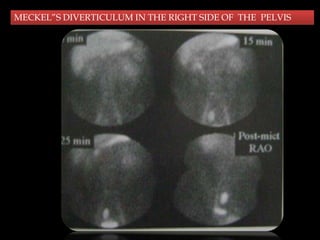 MECKEL”S DIVERTICULUM IN THE RIGHT SIDE OF THE PELVIS

 