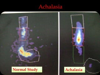 Achalasia

Normal Study

Achalasia

 