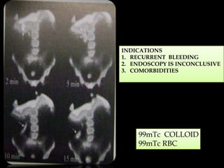 INDICATIONS
1. RECURRENT BLEEDING
2. ENDOSCOPY IS INCONCLUSIVE
3. COMORBIDITIES

99mTc COLLOID
99mTc RBC

 