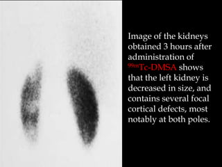 Image of the kidneys
obtained 3 hours after
administration of
99mTc-DMSA shows
that the left kidney is
decreased in size, and
contains several focal
cortical defects, most
notably at both poles.

 
