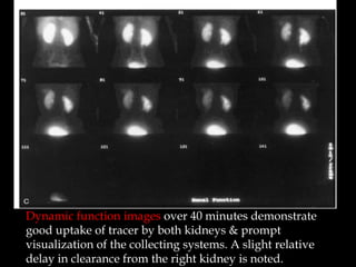 Dynamic function images over 40 minutes demonstrate
good uptake of tracer by both kidneys & prompt
visualization of the collecting systems. A slight relative
delay in clearance from the right kidney is noted.

 