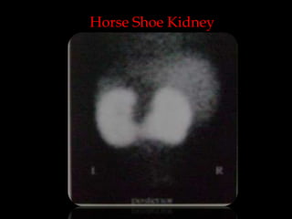 Horse Shoe Kidney

 