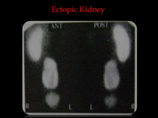 Ectopic Kidney

 