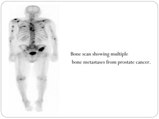 Bone scan showing multiple
bone metastases from prostate cancer.
 
