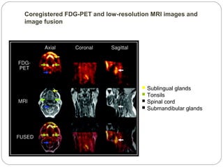 Coregistered FDG-PET and low-resolution MRI images and
image fusion
 Sublingual glands
 Tonsils
 Spinal cord
 Submandibular glands
 