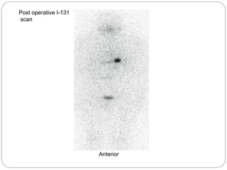 Post operative I-131 
scan 
Anterior 
 