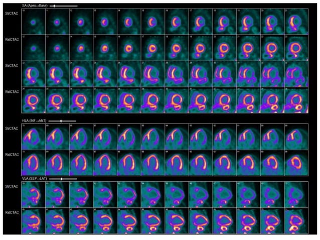 Radionuclide Imaging of Cardiac Amyloidosis and SarcoidosisFELLOWS ...