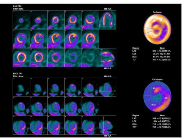 Radionuclide Imaging of Cardiac Amyloidosis and SarcoidosisFELLOWS ...