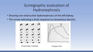 Scintigraphic evaluation of
Hydronephrosis
• Showing non-obstructive hydronephrosis of the left kidney,
• The arrow indicating a brisk response to intravenous diuretic.
 