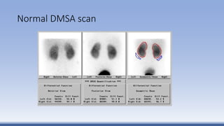Normal DMSA scan
 