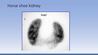 Horse shoe kidney
 