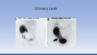 Urinary Leak
 