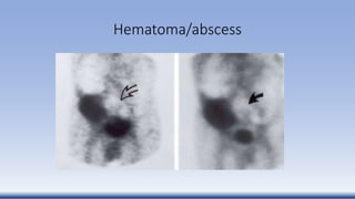 Hematoma/abscess
 
