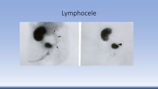 Lymphocele
 