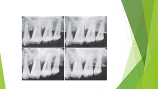 Radiographic aids in the diagnosis of periodontal disease