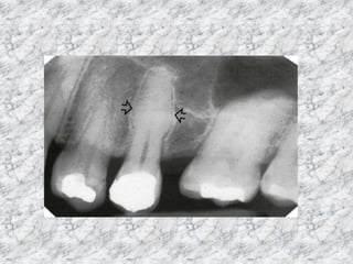radiopacity lesions : radiology lecture. | PPTX