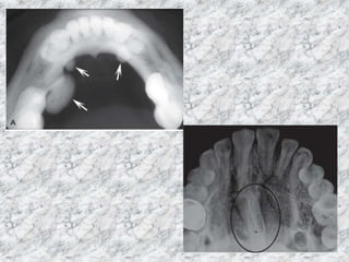 radiopacity lesions : radiology lecture. | PPTX