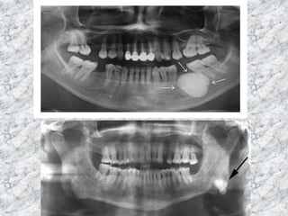 radiopacity lesions : radiology lecture. | PPTX