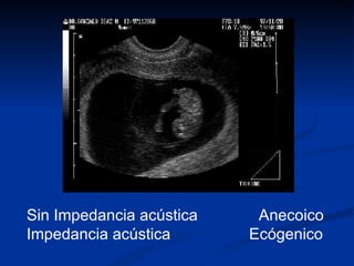 Sin Impedancia acústica  Anecoico Impedancia acústica  Ecógenico 