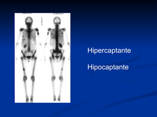 Hipercaptante Hipocaptante 